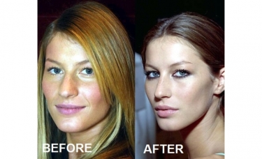 La Rinoplastia de Gisele Bündchen